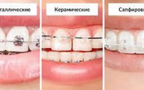 Особливості вибору стоматології для встановлення брекетів у місті Київ